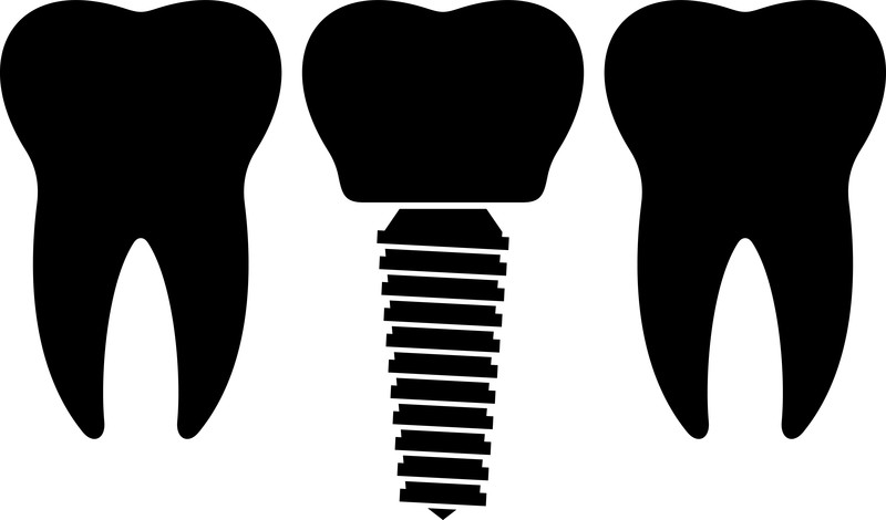 Dental Implants Are Often Preferable for Restoring Missing Teeth