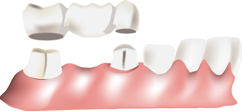 Make the Switch to Implant-Supported Dental Bridges