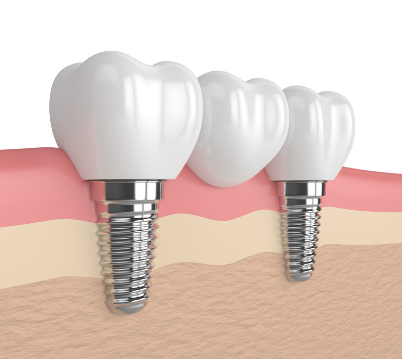 Oral Health ABCs:  Dental Implants