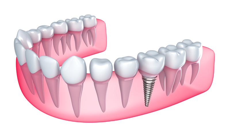 The Benefits of Implant-Supported Dentures