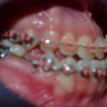 Maxillary & mandibular osteotomy