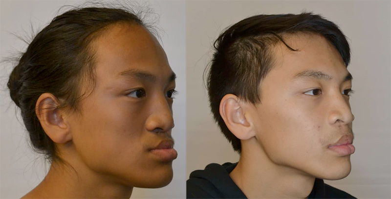 Before and After Mandibular Osteotomy Photos at Aspire Surgical in Salt Lake City, UT
