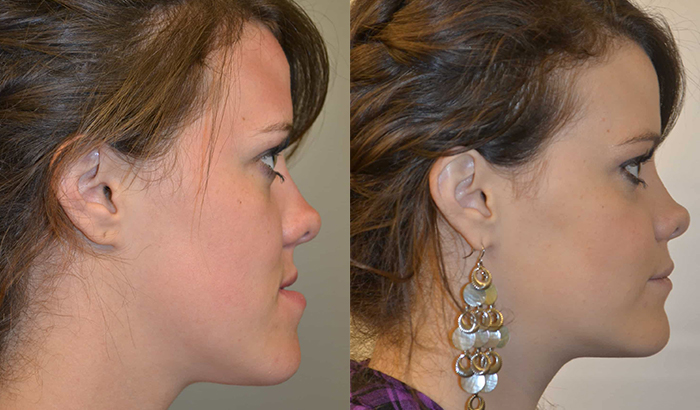 before and after maxillary and mandibular osteotomy with Aspire Surgical in Salt Lake City, UT