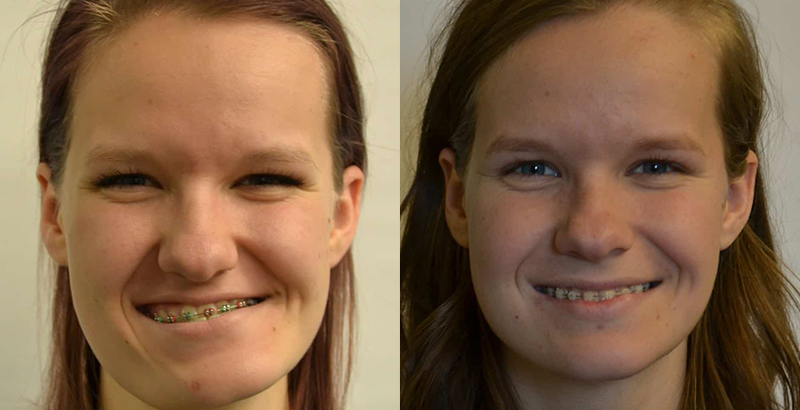 Before and After of a Maxillary and Mandibular Osteotomy and Genioplasty at Aspire Surgical