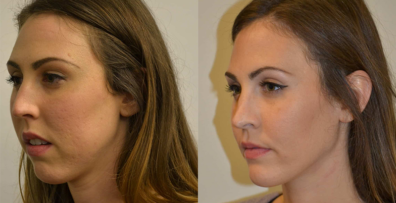 before and after orthognathic surgery with Aspire Surgical in Salt Lake City, UT