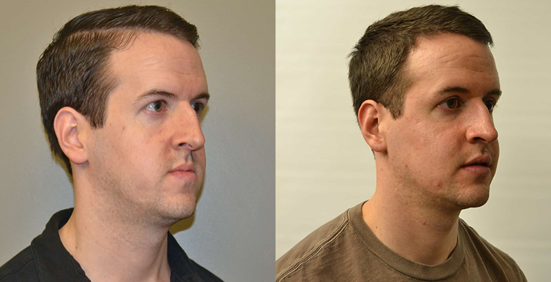 before and after osteotomy and rhinoplasty with Aspire Surgical in Salt Lake City, UT
