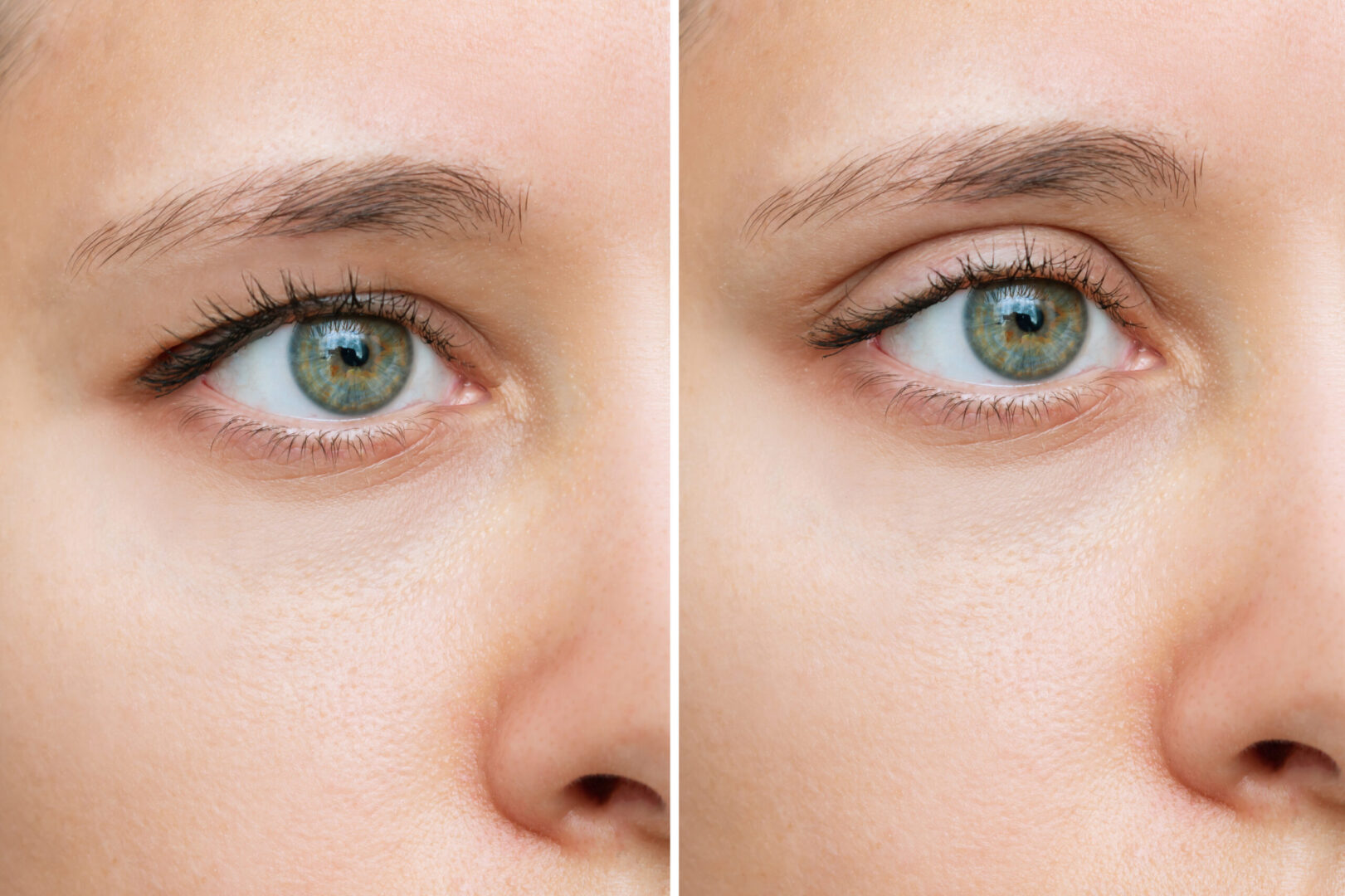 Blepharoplasty enhances the appearance of your eyes by treating facial issues with Aspire Surgical in Salt Lake City, UT