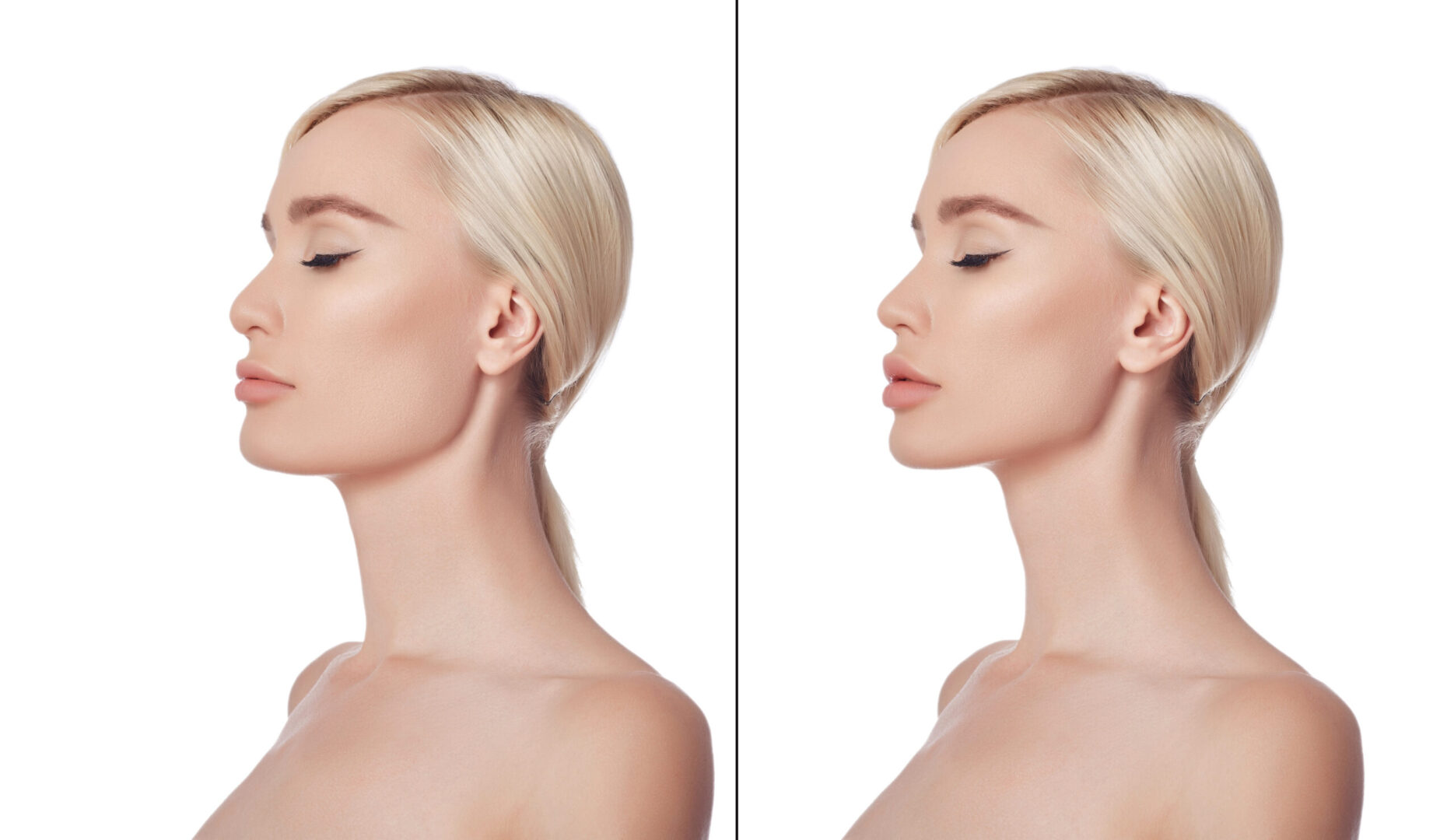 chin augmentation procedure provided by Aspire Surgical in the Salt Lake City, UT areaPortrait beautiful young woman after plastic surgery