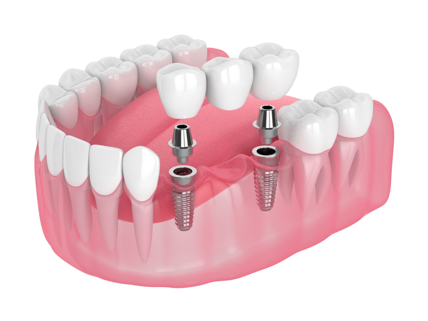dental implant bridge utilizes the jawbone for stability at Aspire Surgical in Salt Lake City, UT