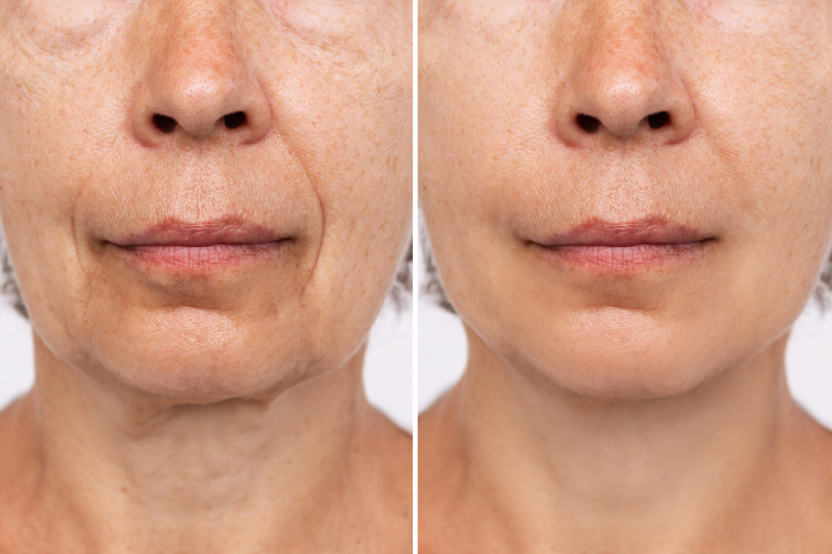 facelift before and after results at Aspire Surgical in Salt Lake City, UT