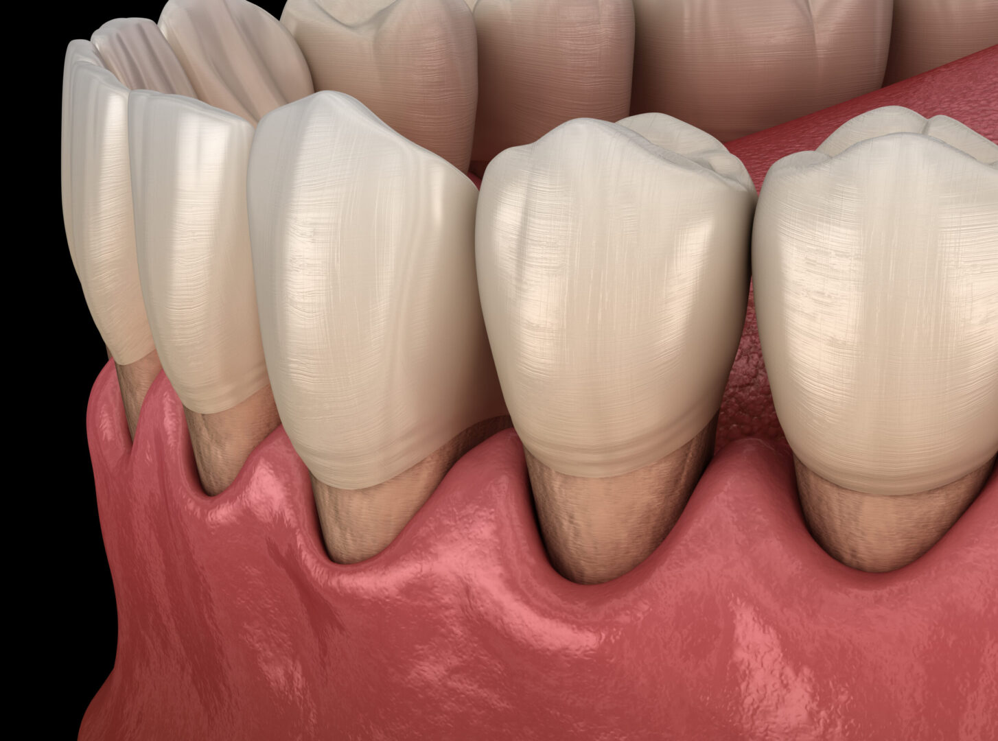 gingival grafting can solve gum recession at Aspire Surgical in Salt Lake City, UT