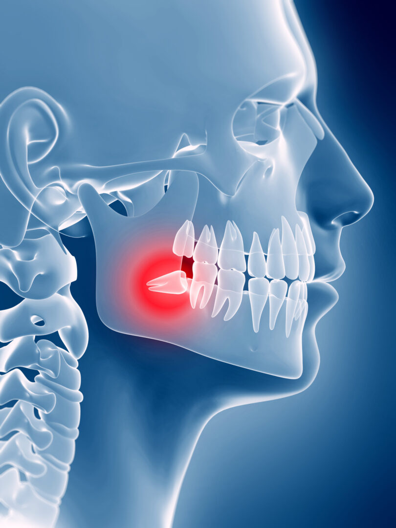 impacted wisdom tooth treatment at Aspire Surgical in Salt Lake City, UT