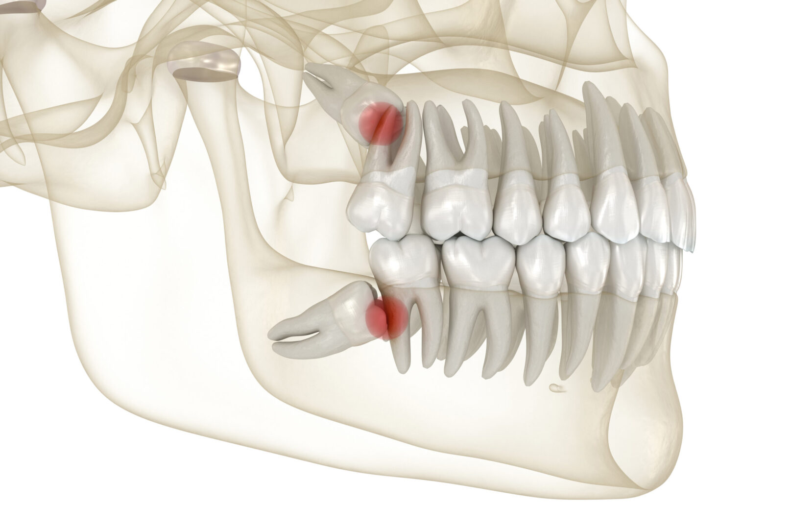 Mesial impaction of Wisdom teeth to the second molar needs extraction at Aspire Surgical in Utah.