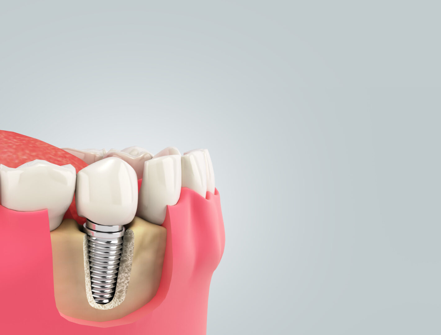 replace a tooth with a single dental implant at Aspire Surgical in Salt Lake City, UT