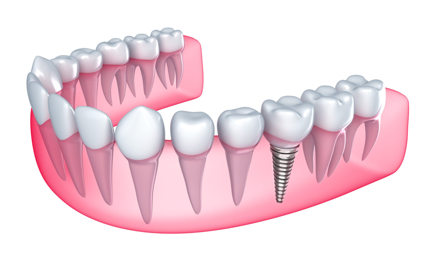 single tooth dental implants with Aspire Surgical in Salt Lake City, UT