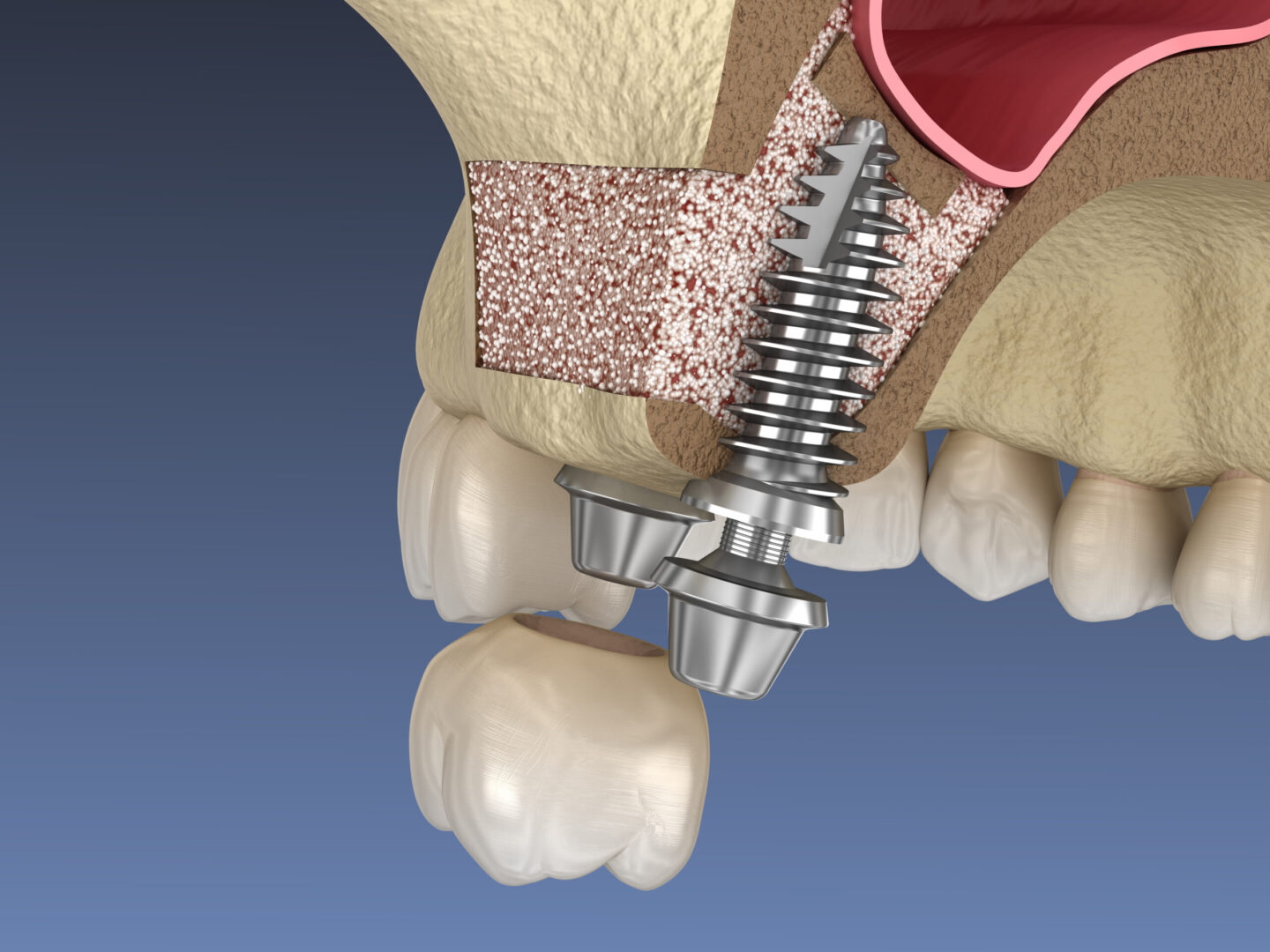 Sinus Lift Surgery and implant installation with Aspire Surgical in Salt Lake City, UT