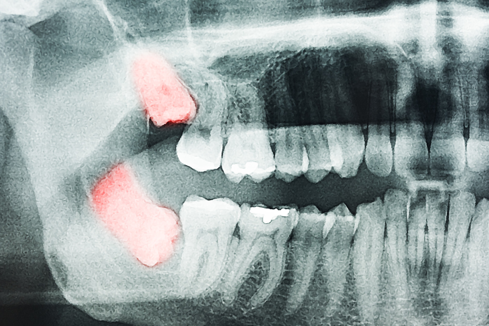wisdom teeth x-rays
